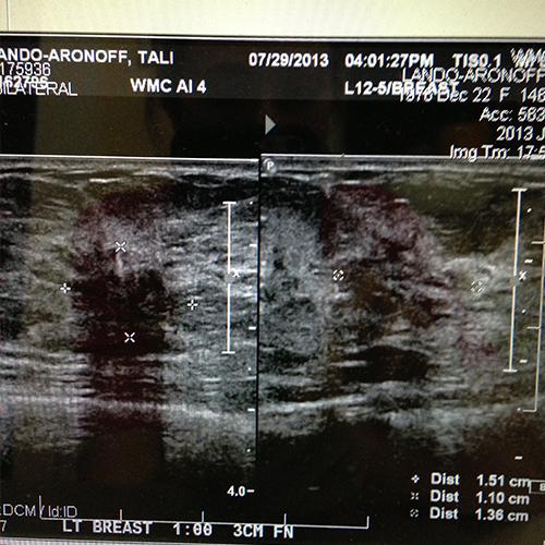 Breast ultrasound of tumor.jpg
